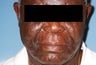 Male Patient Treated with Sculptra