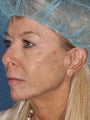 56 year old female with wrinkles around mouth and eyes