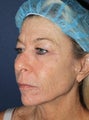 56 year old female with wrinkles around mouth and eyes