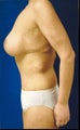 body lift