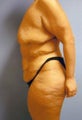 body lift
