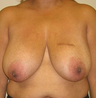 Breast Lift