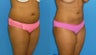 34 Year Old Female Underwend Liposuction and Fat Transfer to Buttocks (BBL)