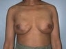 Female patient who underwent breast reconstruction