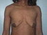 Female patient who underwent breast reconstruction
