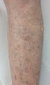 Vein Treatment Before and After on the Legs