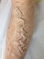 Vein Treatment Before and After on the Legs
