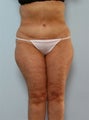 Body Lift