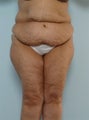 Body Lift