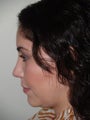 Before and After Revision Rhinoplasty