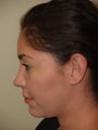 Before and After Revision Rhinoplasty