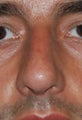 Rhinoplasty, Deviated Septum