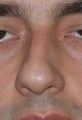 Rhinoplasty, Deviated Septum