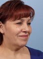 Female Chin/Neck Liposuction