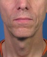 Direct Smile Line Excision Permanent Treatment for Nasolabial Folds