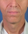 Direct Smile Line Excision Permanent Treatment for Nasolabial Folds