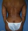 liposuction abdomen and back