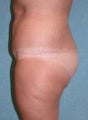 Buttock Augmentation with Circumferential Body Lift