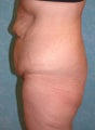 Buttock Augmentation with Circumferential Body Lift