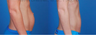 Mini Tummy Tuck with Diastasis Repair