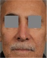 68 year old male with post rhinoplasty deformity prefers non surgical, "Injectable Rhinoplasty" treatment