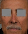 68 year old male with post rhinoplasty deformity prefers non surgical, "Injectable Rhinoplasty" treatment