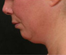 Liposuction