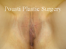 Labial Reduction