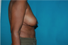 6 Month Post Operative Breast Reduction