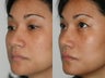 Female Asian Revision Rhinoplasty