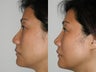 Female Asian Revision Rhinoplasty