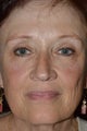 61 Year Old Female Treated for Heavy Eyelids and Decending Eyebrow