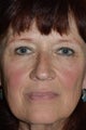 61 Year Old Female Treated for Heavy Eyelids and Decending Eyebrow