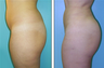 Brazilian Butt Lift Before & After