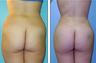 Brazilian Butt Lift Before & After