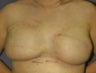Breast Reconstruction