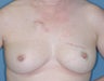 Breast Reconstruction