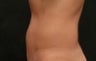 Coolsculpting 44 year Old