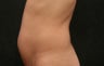 Coolsculpting 44 year Old