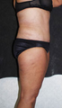 Liposuction & Abdominoplasty