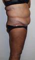 Liposuction & Abdominoplasty