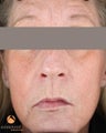 Female After 1 ePrime™: The Evolastin™ Procedure