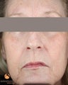 Female After 1 ePrime™: The Evolastin™ Procedure