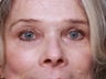 Brow Lift