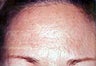 Female Botox