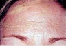 Female Botox
