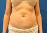 CoolSculpting