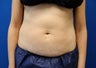 CoolSculpting