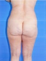 Liposuction