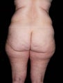 Liposuction